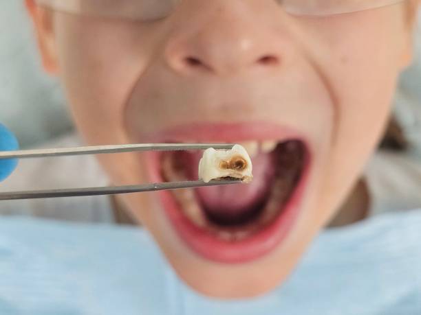 Best Emergency Dental Care for Broken or Chipped Teeth in Stapleton, AL
